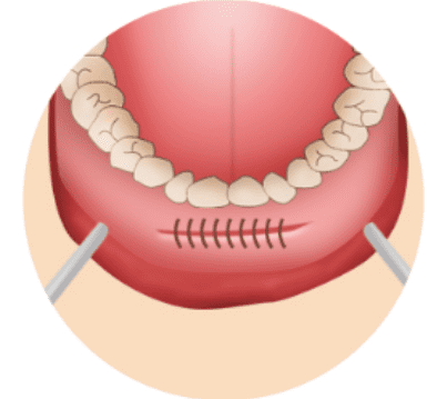 Illustration of making a tiny incision in the chin mucosa for chin implant surgery.