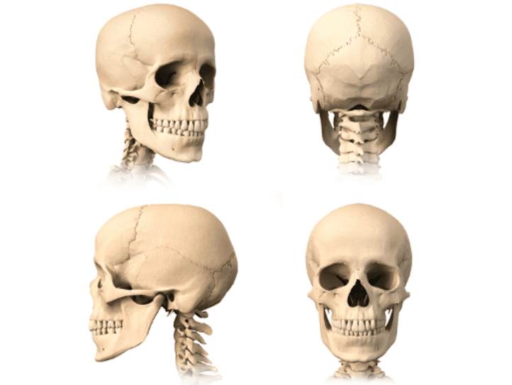 Comparison of skulls showing changes in chin structure before and after chin implant surgery.