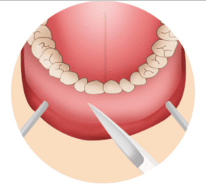 Illustration of closing the incision with absorbable sutures after chin implant surgery