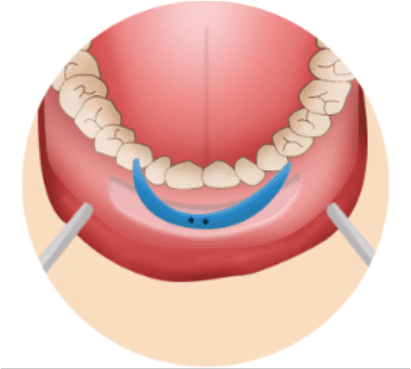 Illustration of inserting a custom-made chin implant and securing it firmly.