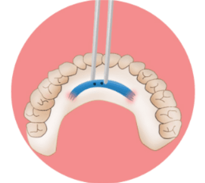 Illustration of elevating the periosteum to create space for the chin implant.