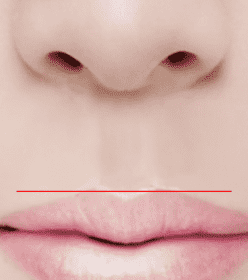 Diagram showing the reduced length of the philtrum after the incisional method.