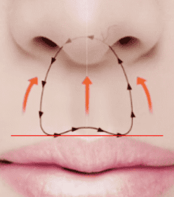 Illustration of the incisional philtrum reduction technique showing incision and lifting.