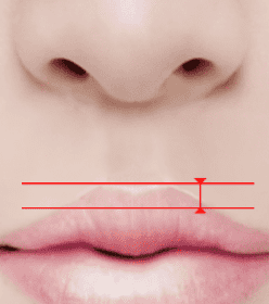 Diagram depicting the reduced length of the philtrum after non-incisional method.