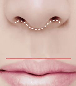 Illustration showing the path of the thread for non-incisional philtrum reduction.