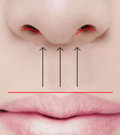 Diagram indicating insertion points for non-incisional philtrum reduction.