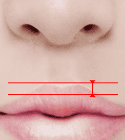 Illustration showing the measurement of the philtrum for reduction.