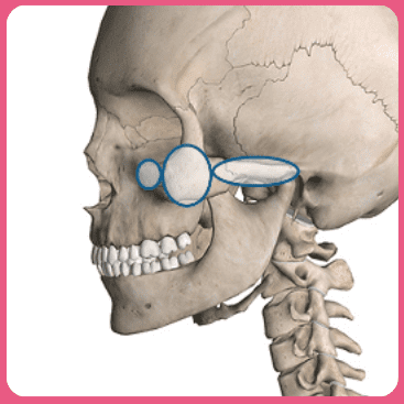 Diagram illustrating the steps of cheekbone surgery for under-eye front cheekbone