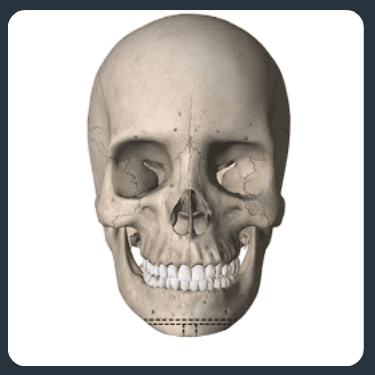 Diagram showing the skeletal structure after T-osteotomy surgery.