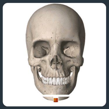 Diagram showing the skeletal structure after jaw surgery.