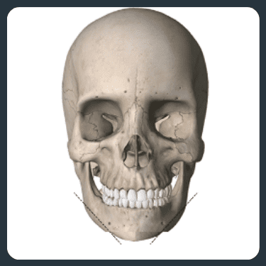 Diagram showing the skeletal structure after cheekbone reduction surgery.