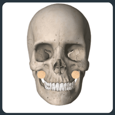 Diagram showing the steps for reducing the side cheekbone in front of the ear