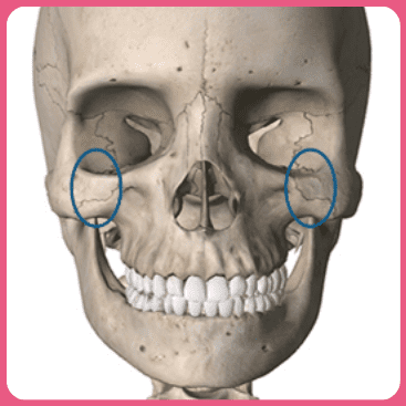 Diagram showing the areas of the main body and zygomatic arch for cheekbone surgery