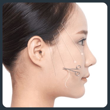 Illustration showing the side view of a woman's face, with lines indicating the areas where the thread lift is applied to improve facial contour