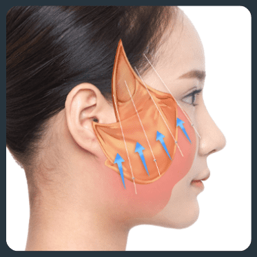 Illustration of a thread lift procedure on a woman’s face, highlighting the lift from the jawline to the cheek area.