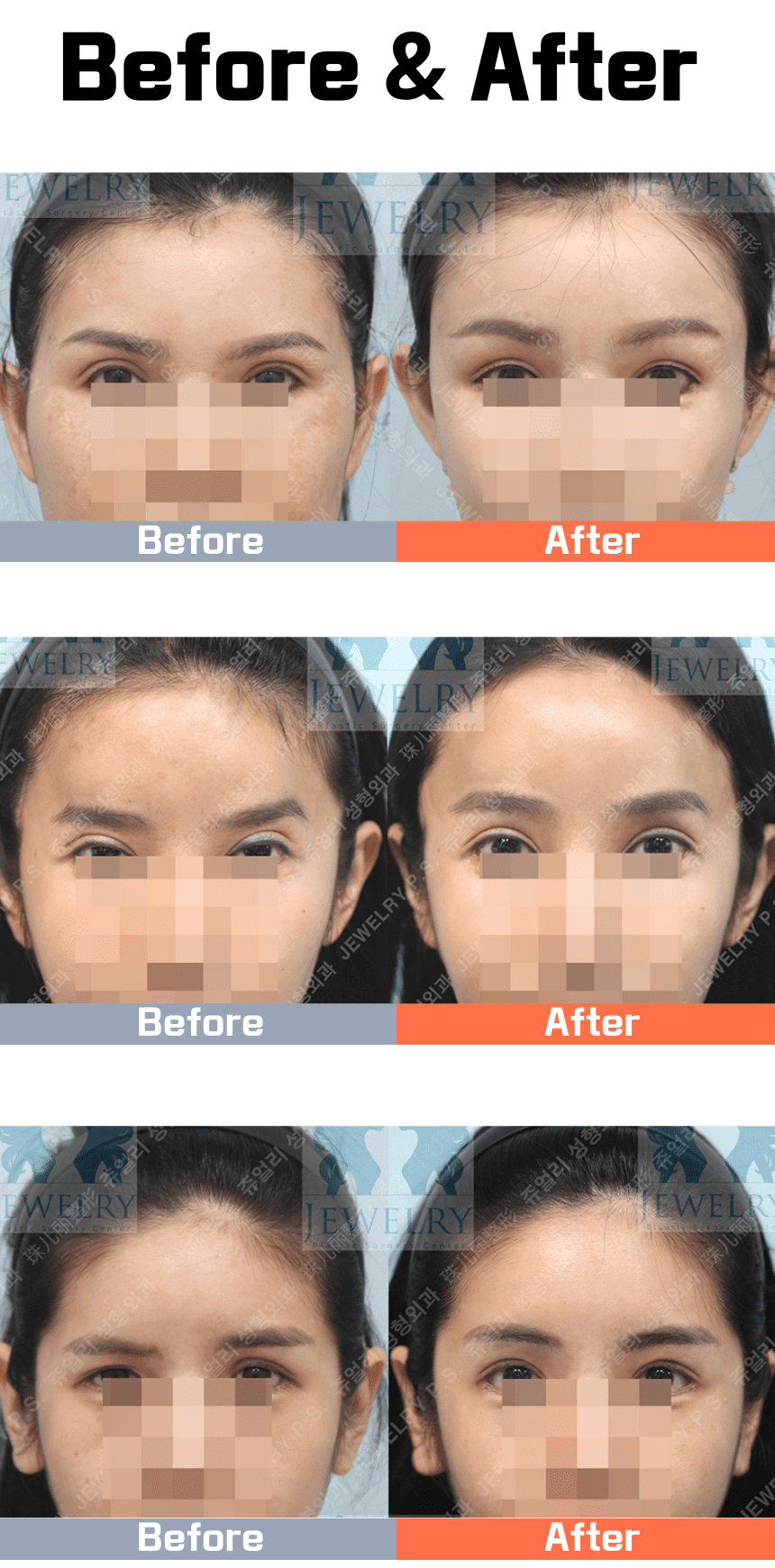 Before and after images showing facial improvements from the thread lift procedure, focusing on symmetry and wrinkle reduction.