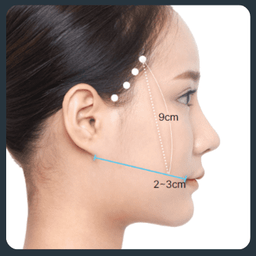 Side view of a woman's face during a thread lift procedure, showing the insertion points and the direction of lift for a V-line effect.